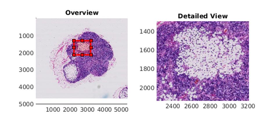 Image of a lymph node containing tumor tissue displayed with <code>bigimageshow</code> in MATLAB.