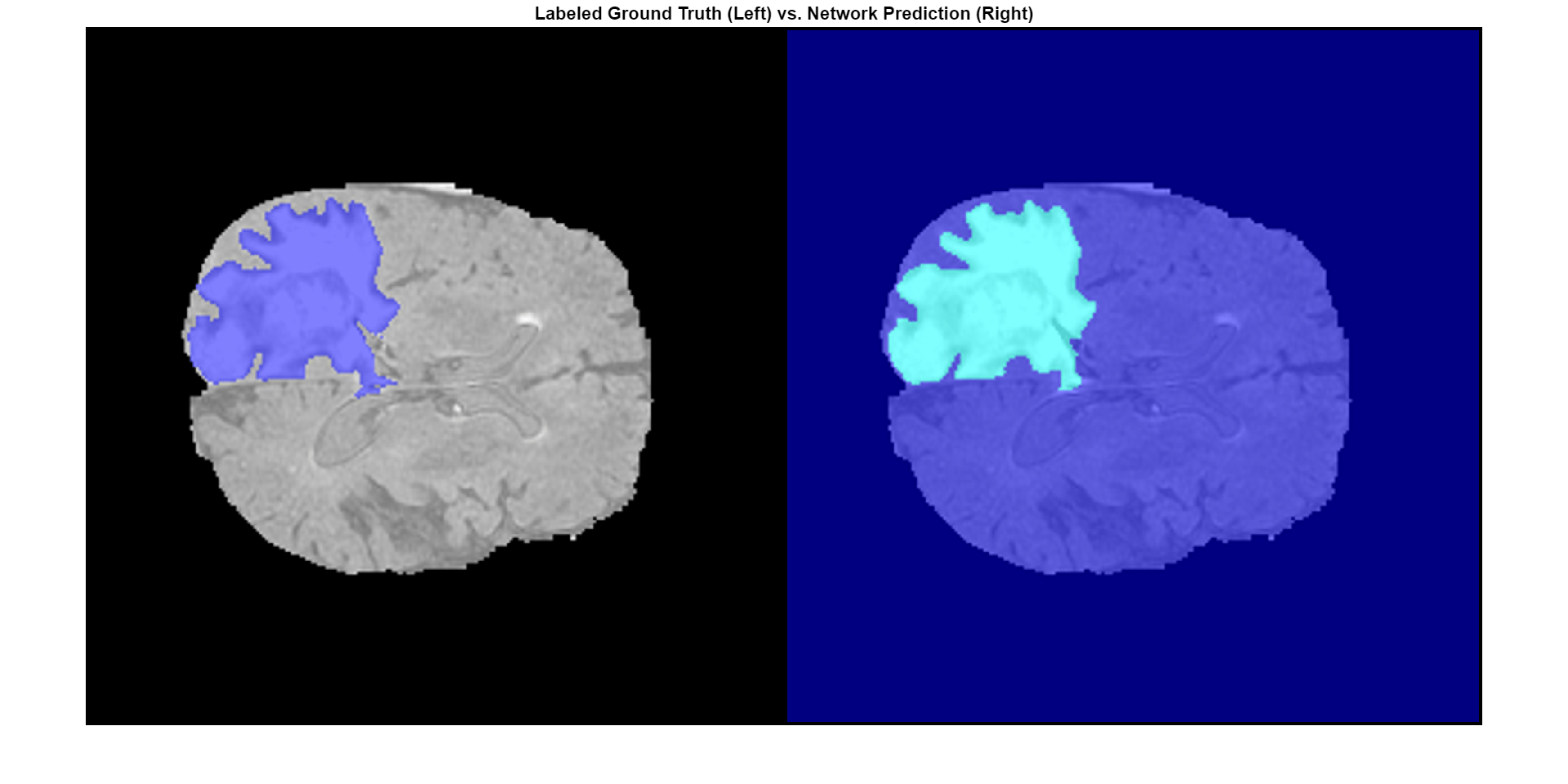 3-D Brain Tumor Segmentation Using Deep Learning