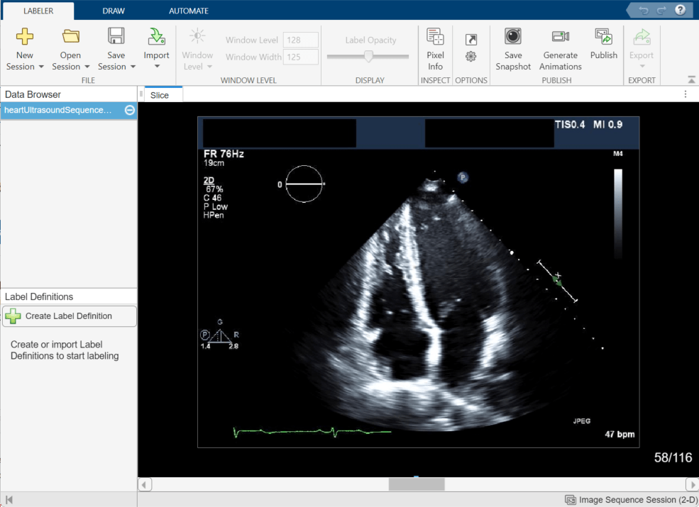 Medical Image Labeler app image session with one echocardiogram image series loaded in the Data Browser