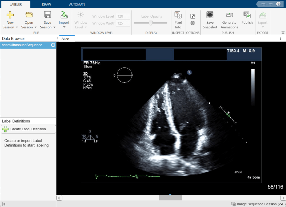 Slice pane with ventricle region to label circled